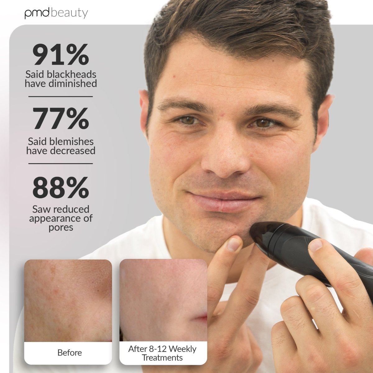 Personal Microderm Pro