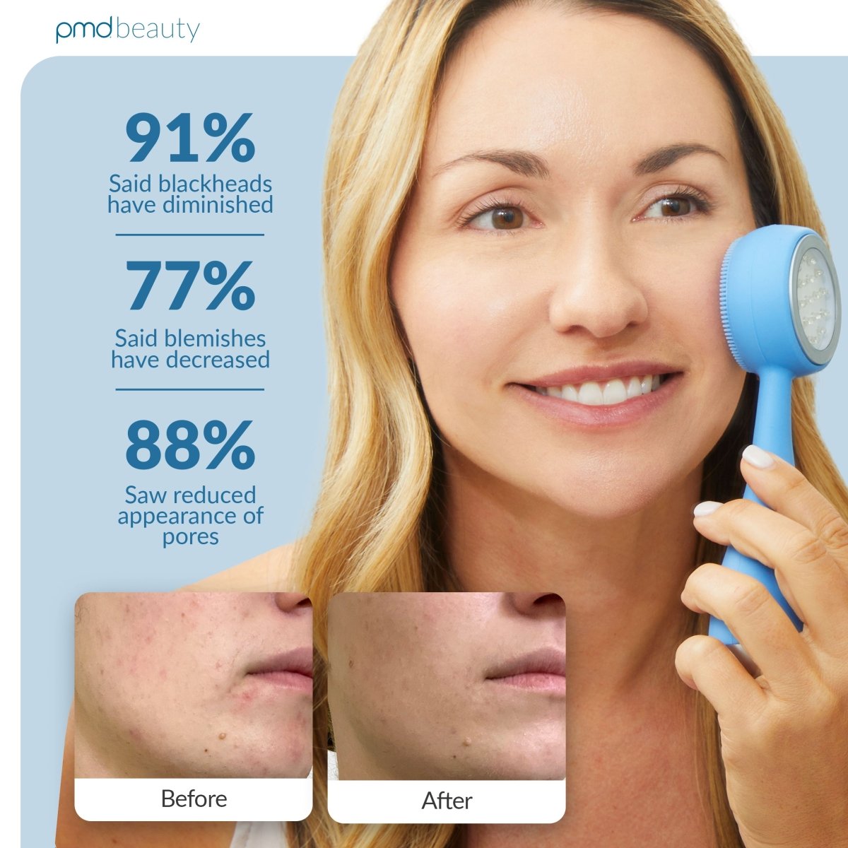 PMD Clean Acne - Man