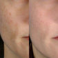 Personal Microderm Classic