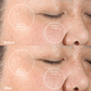 4001-PINK?Clinical trial Before & After using the PMD Clean